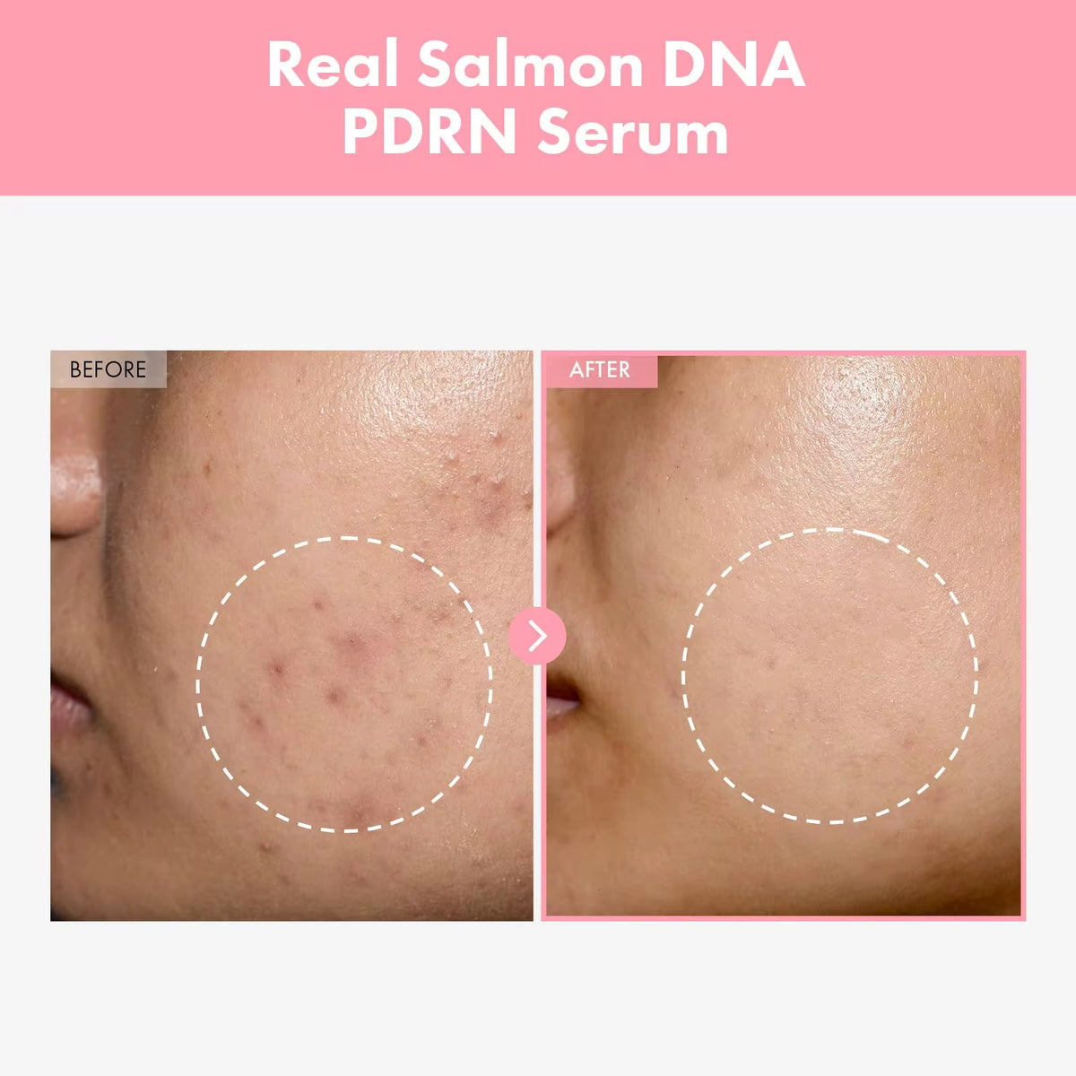 Moisturizing, Hydrating Glass Skin Pink Peptide 12 Salmon DNA PDRN Serum with Hydrolyzed  Collagen Bakuchiol for Glowy Skin
